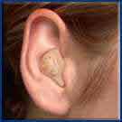 oreille appareillée avec un intra conque